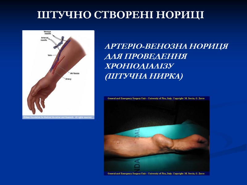 ШТУЧНО СТВОРЕНІ НОРИЦІ АРТЕРІО-ВЕНОЗНА НОРИЦЯ ДЛЯ ПРОВЕДЕННЯ ХРОНІОДІАЛІЗУ ШТУЧНО СТВОРЕНІ НОРИЦІ АРТЕРІО-ВЕНОЗНА НОРИЦЯ ДЛЯ ПРОВЕДЕННЯ ХРОНІОДІАЛІЗУ